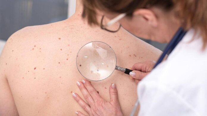Cómo es la vacuna argentina contra el cáncer de piel más grave