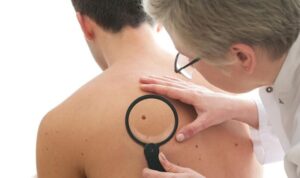 Cómo cuidar la piel del sol para evitar desarrollar cáncer